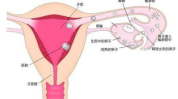 输卵管堵塞症状,症状、原因及防治策略”